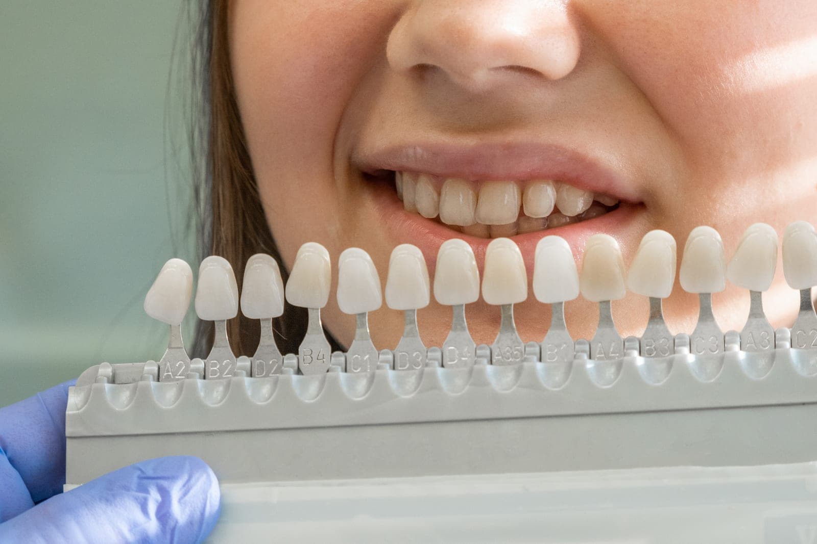 Carillas dentales en Arcodental Getafe