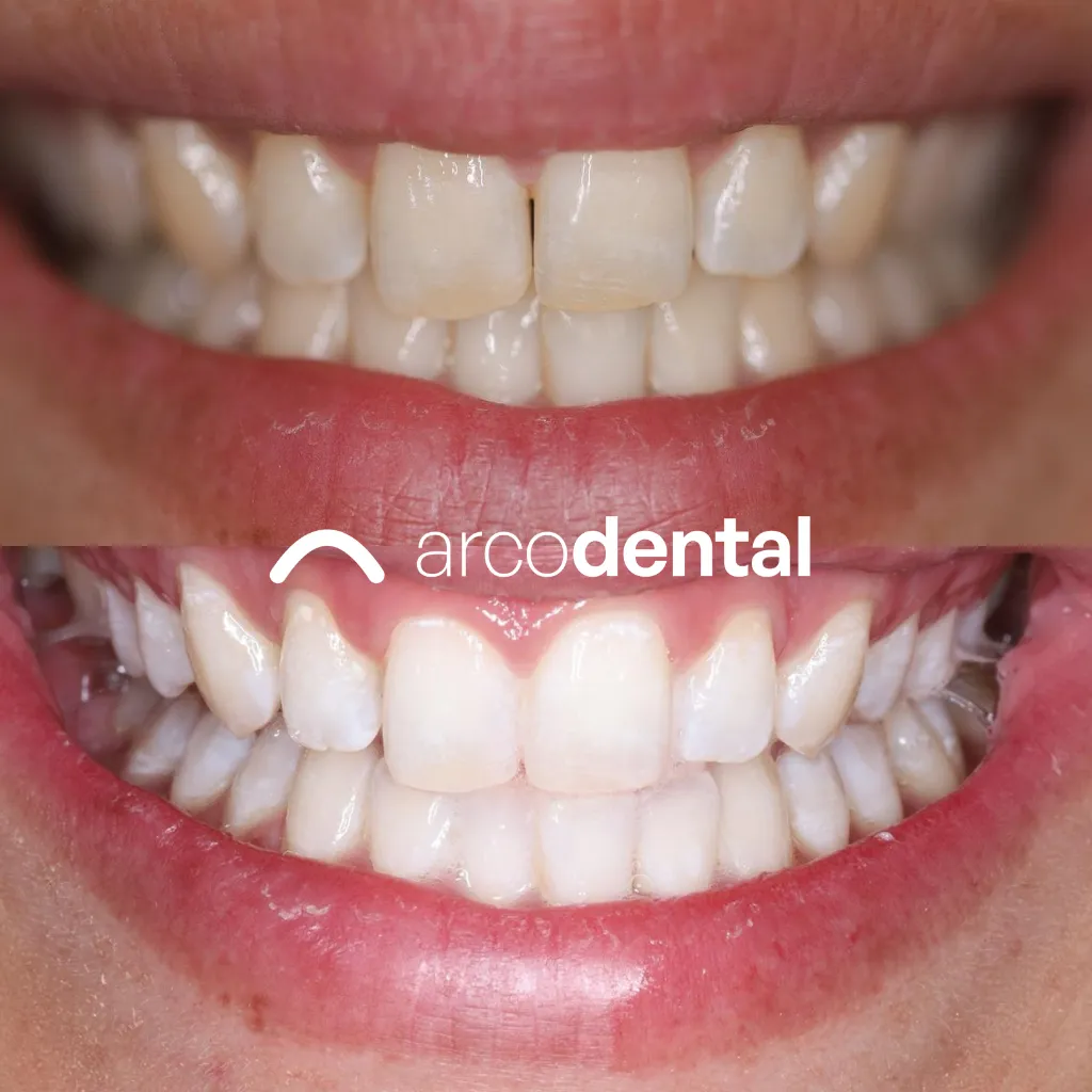 Blanqueamiento dental antes y después · caso real en Arcodental Getafe