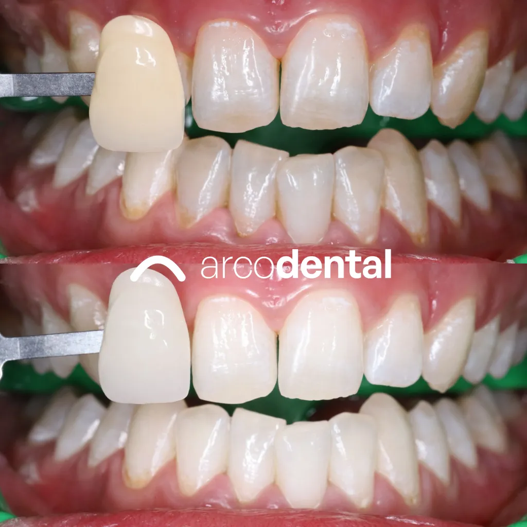 Blanqueamiento dental con guía de color antes y después · paciente de Getafe