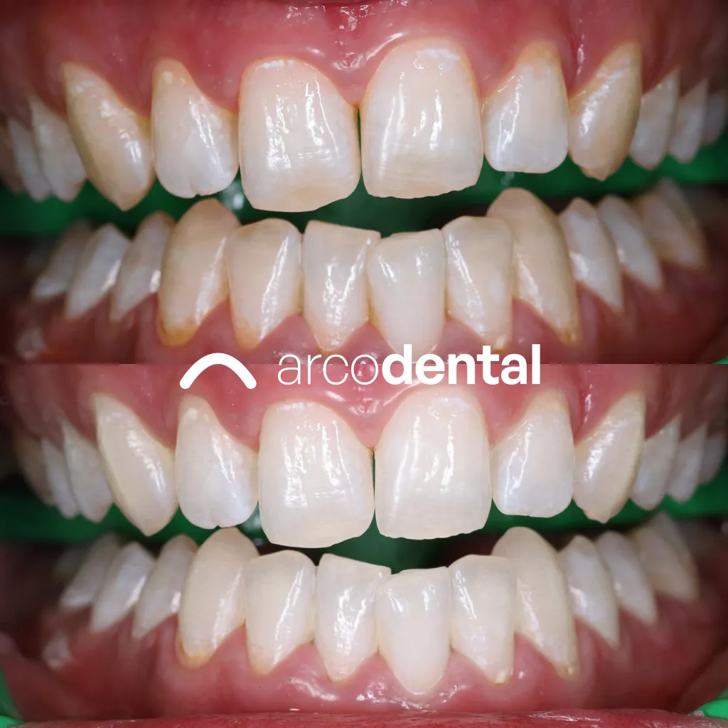 Resultado de blanqueamiento dental antes y después · Arcodental Getafe