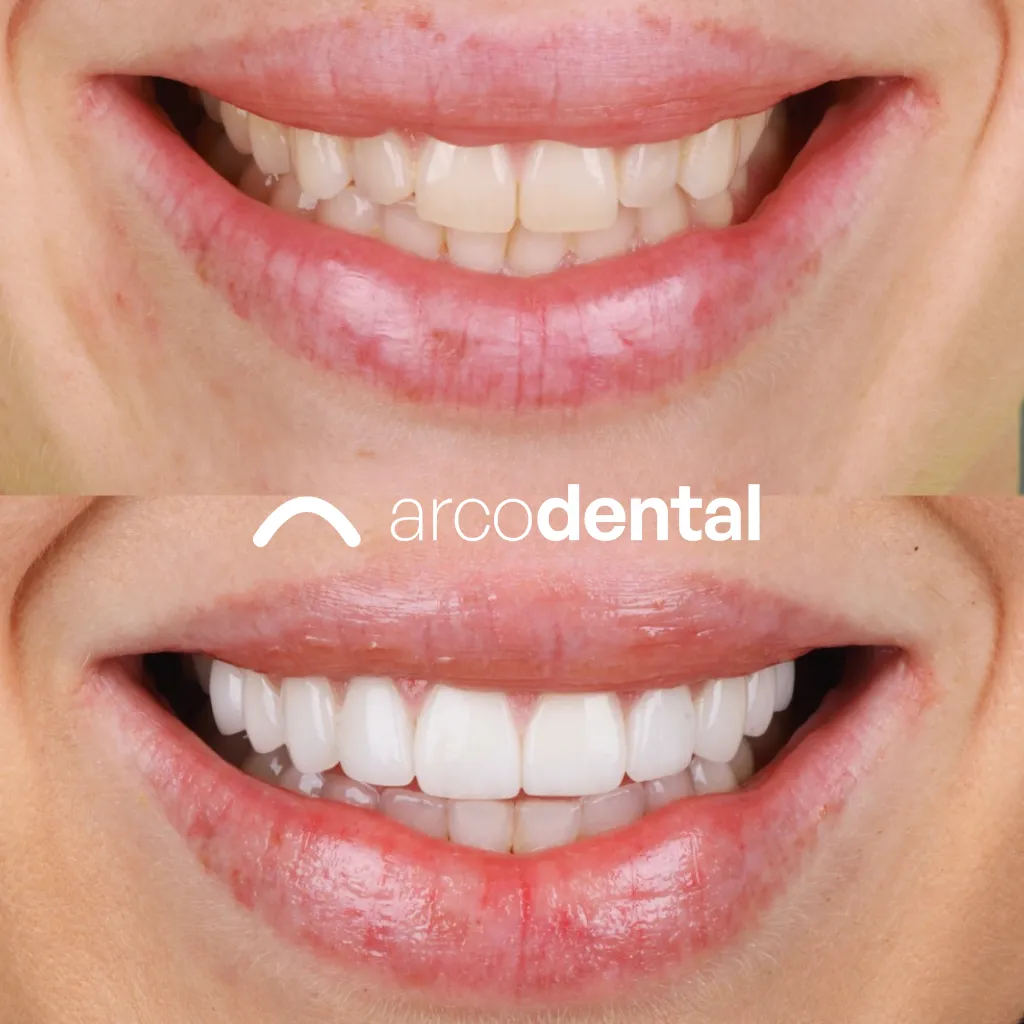 Carillas dentales antes y después · caso real en Arcodental Getafe