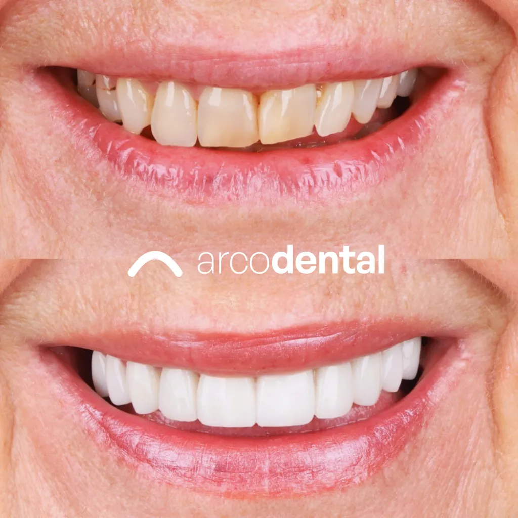 Rehabilitación con carillas antes y después · Arcodental Getafe