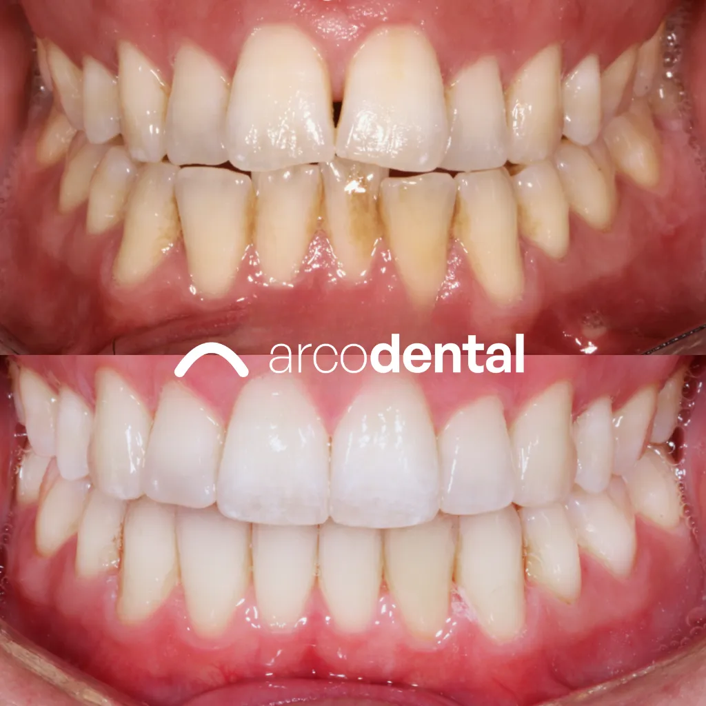 Alineación con Invisalign antes y después · Arcodental Getafe