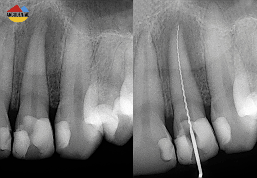 Extracción de muelas del juicio en Arcodental Getafe