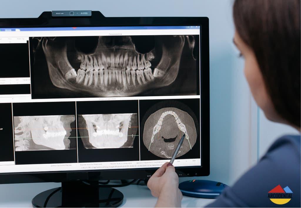 Injerto de hueso dental en Arcodental Getafe