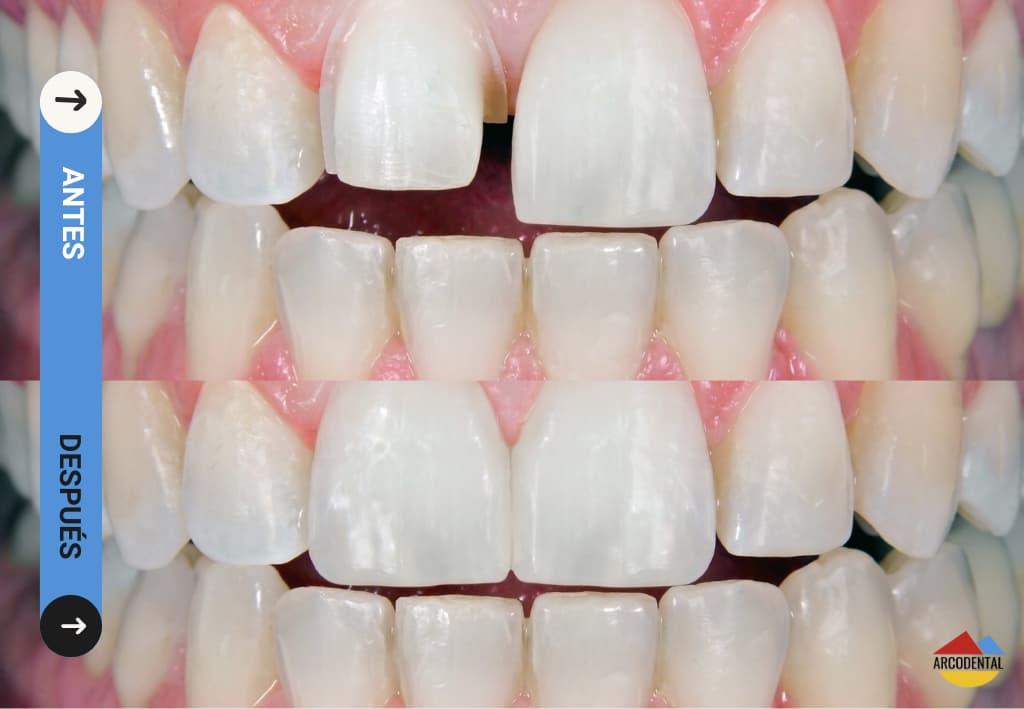 Paciente con implantes de carga inmediata en Arcodental Getafe