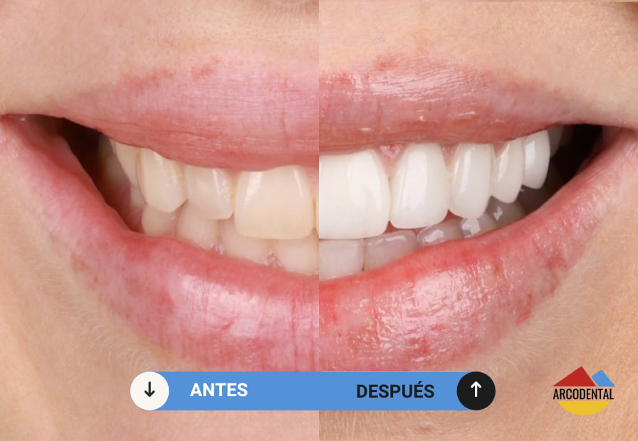 blanqueamiento dental en getafe