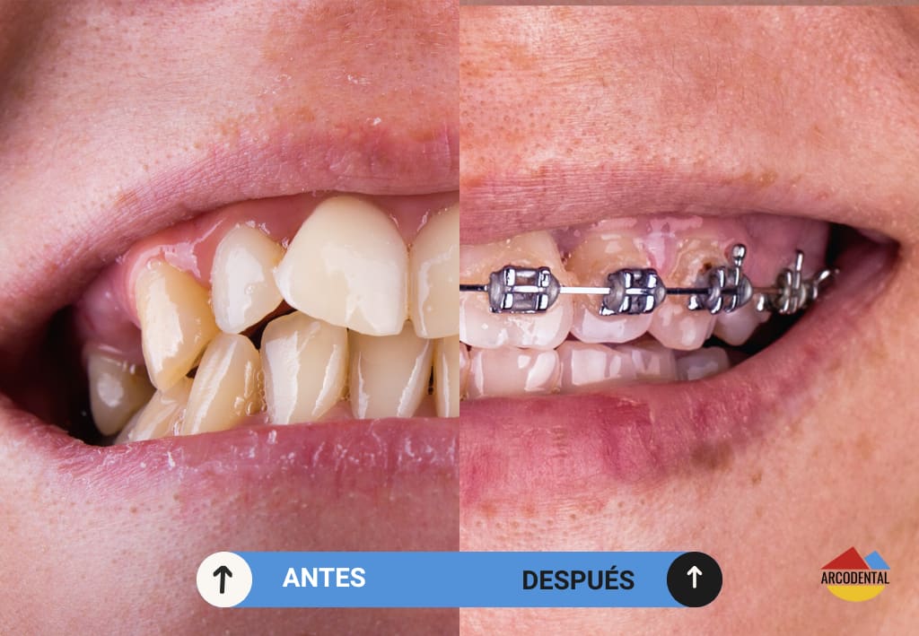 brackets en getafe