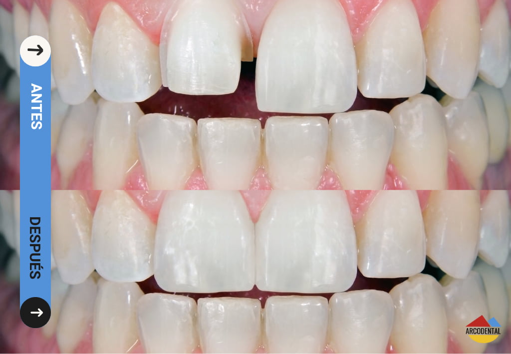 carilla dental en getafe