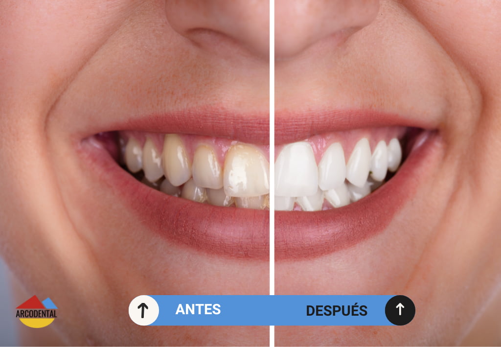 limpieza dental getafe