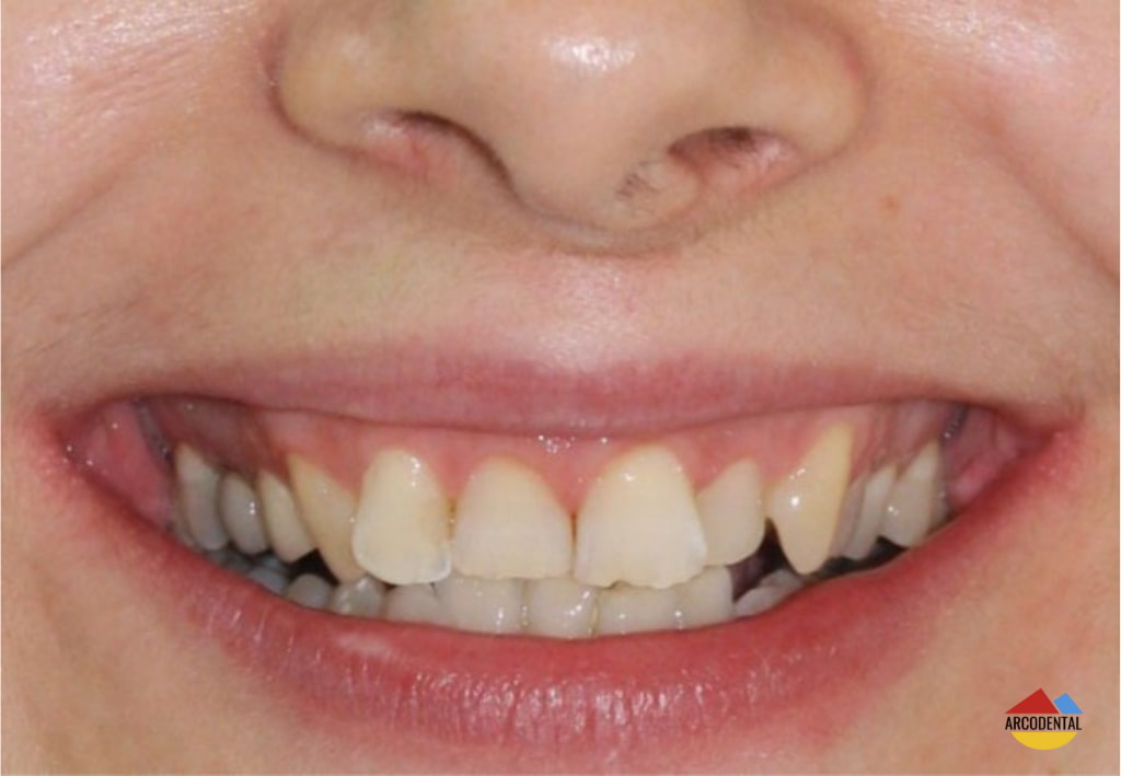 Antes